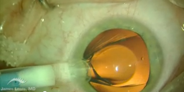 Bilateral Staar Vision ICL in HD